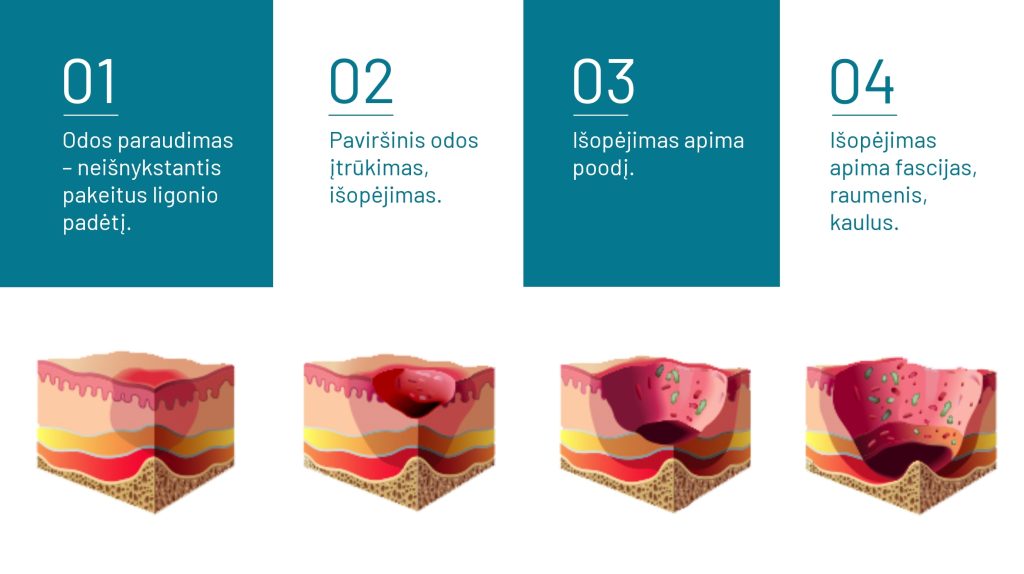 Kaip įvertinti pragulų riziką? Sužinokite, kaip vertinti pragulų riziką remiantis Nortono skale. Čiužinys nuo pragulų priemonės nuo pragulų